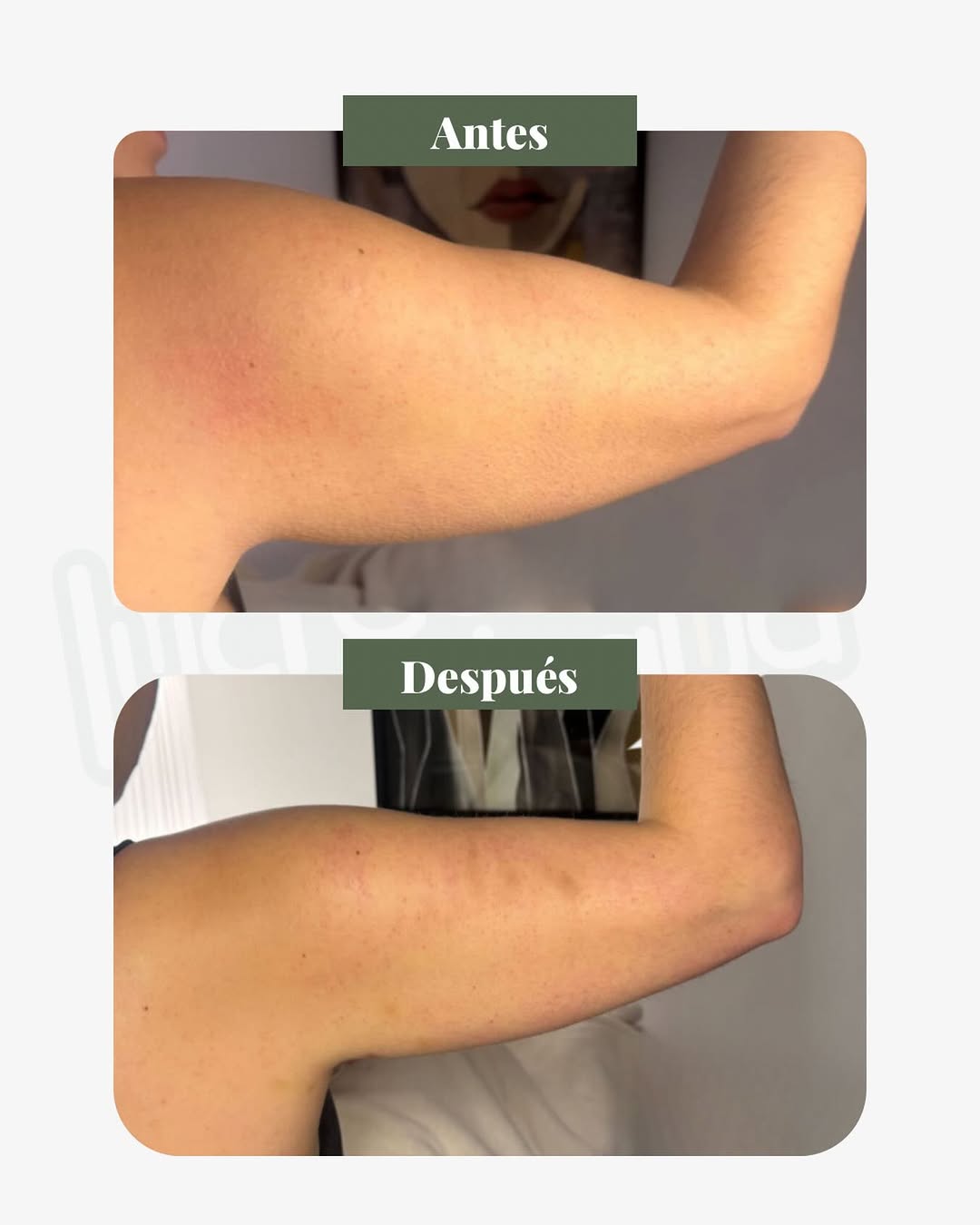 Antes y después de HIFU 22D en zona de brazos